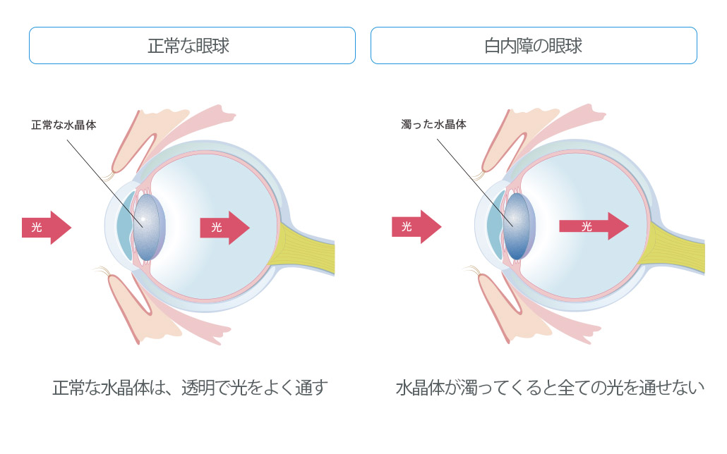 白内障の仕組み