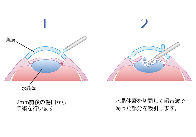 超音波水晶体乳化吸引術