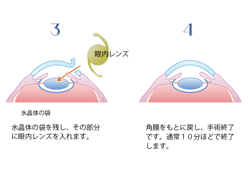 超音波水晶体乳化吸引術