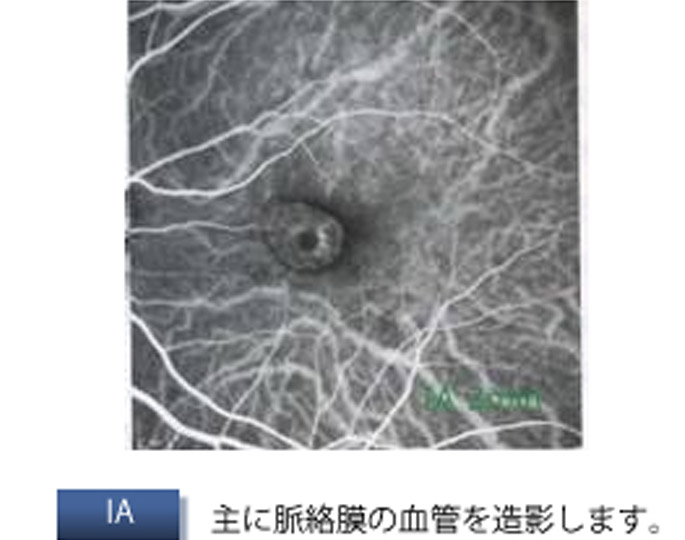 蛍光眼底造影