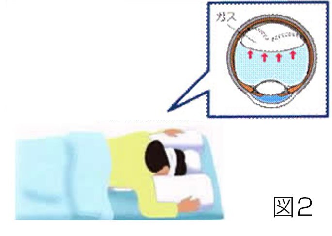 網膜硝子体手術の治療