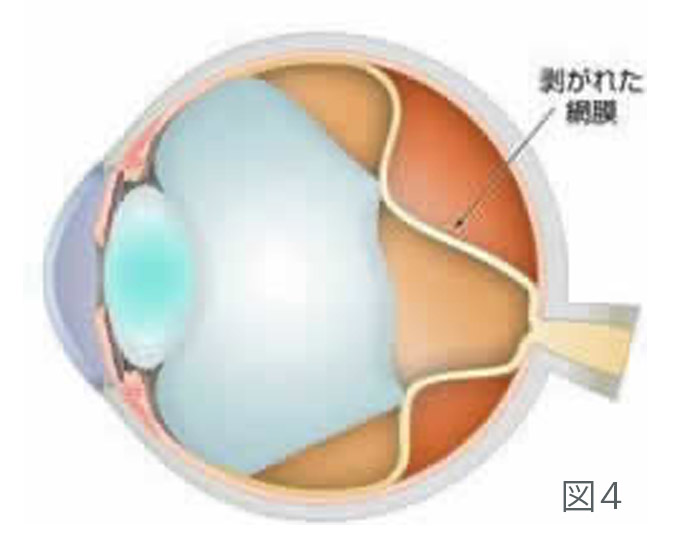 白内障の仕組み